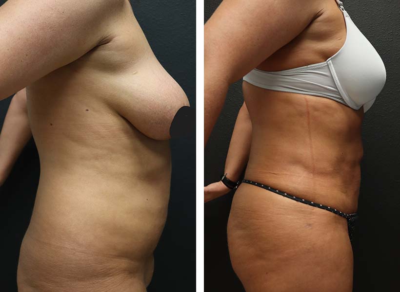 Liposuction results