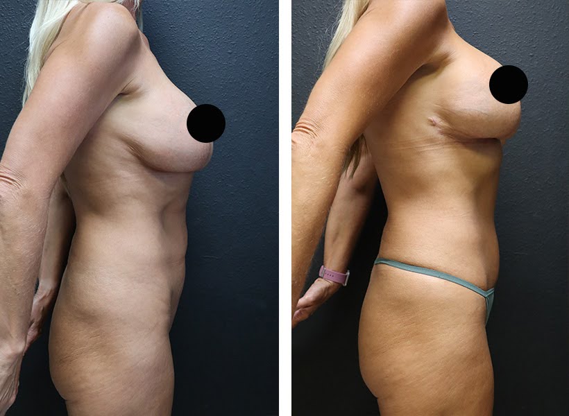 After and before image of Reverse tummy tuck surgery 01