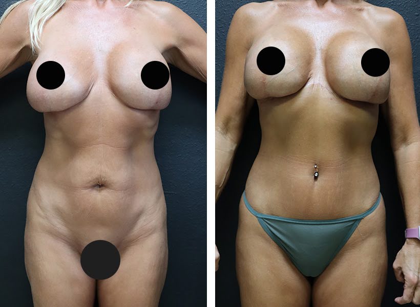 After and before image of Reverse tummy tuck surgery 02