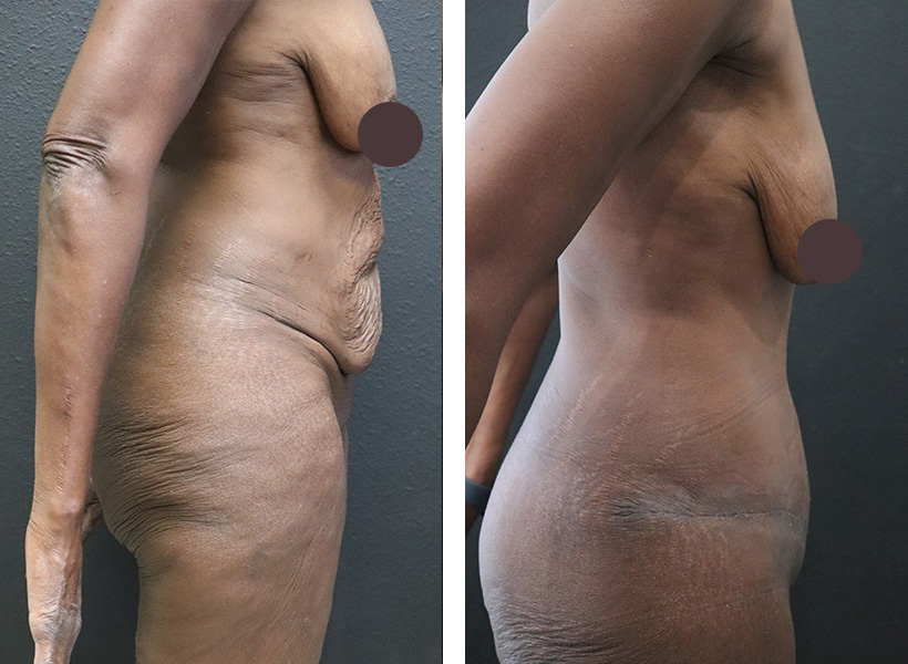 Before after Fleur-de-lis Tummy Tuck 01