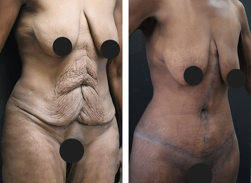 Before after Fleur-de-lis Tummy Tuck 02
