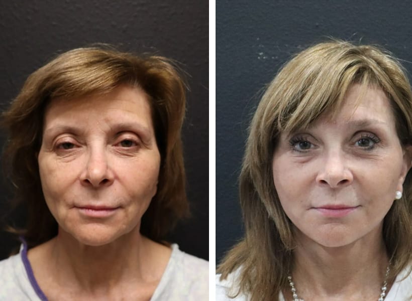 Before after Facelift Revision Surgery 01