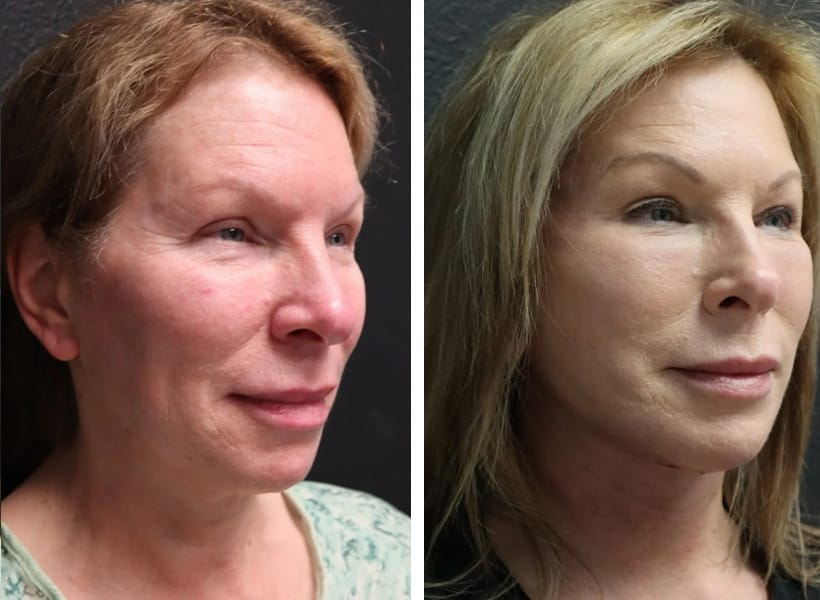 Facelift Surgery