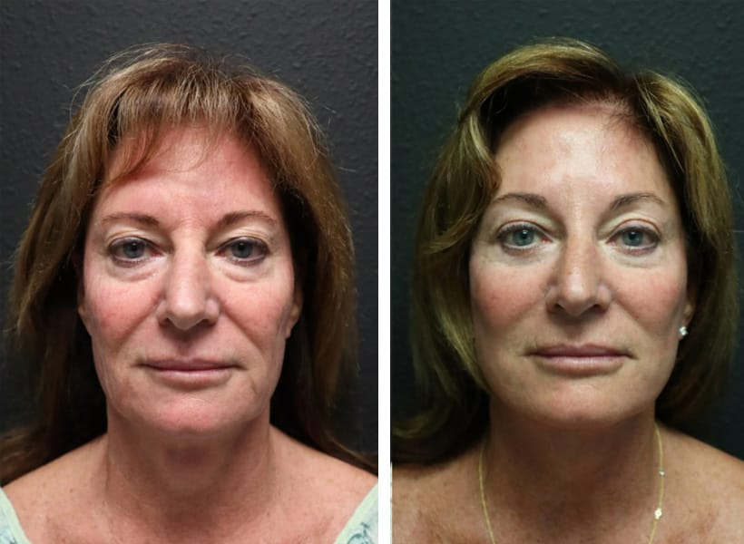 Facelift Surgery