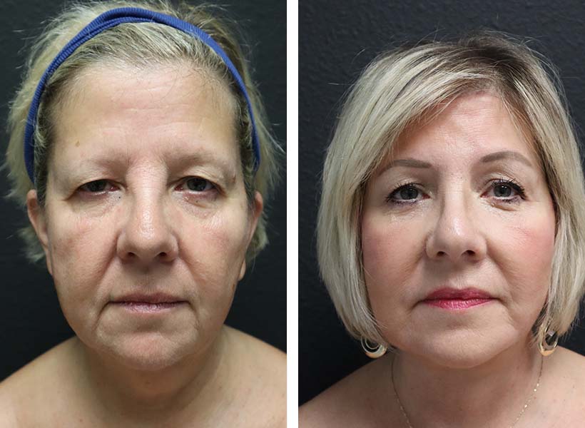 Before after Facelift Revision Surgery 02