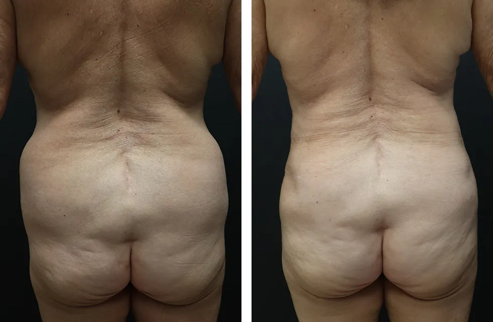 Before & after Lipo 360 case