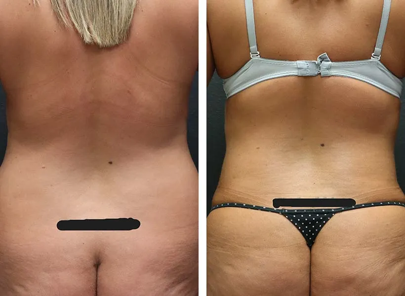 Before & after liposuction 360 case