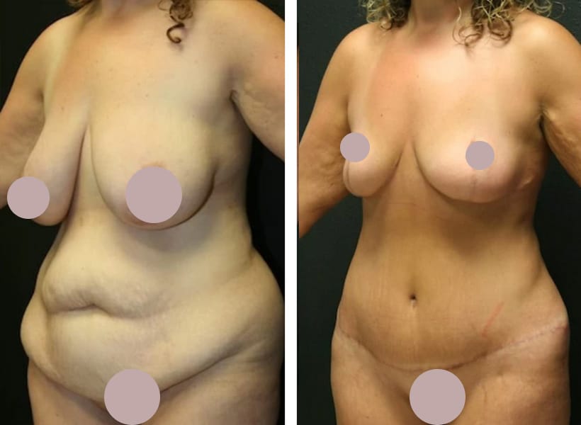 Mini Tummy Tuck Surgery