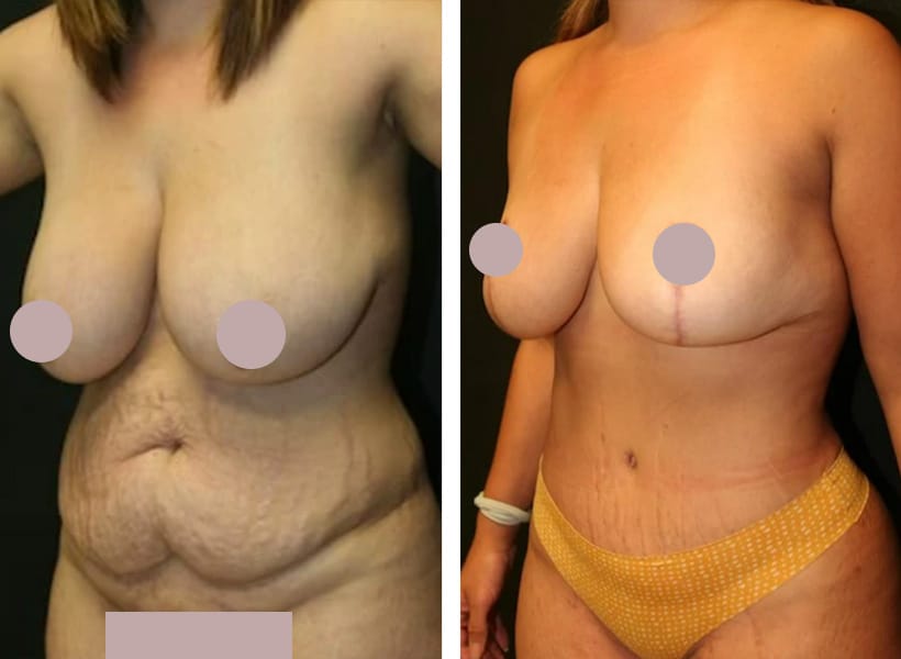 Mini Tummy Tuck Surgery