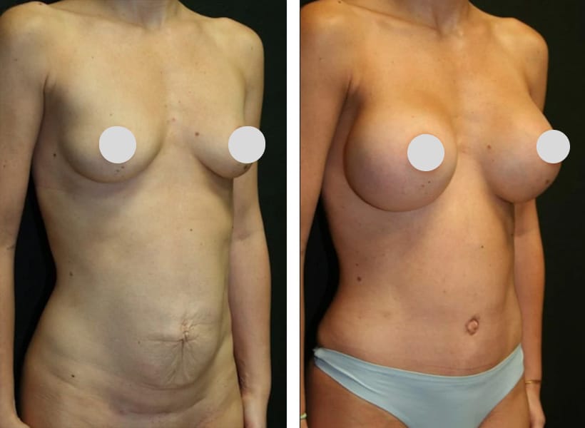 Mini Tummy Tuck Surgery