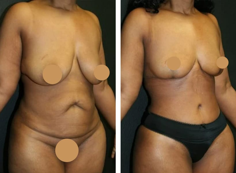 Mini Tummy Tuck Surgery