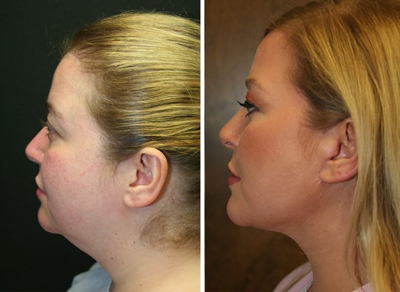Neck lift side left