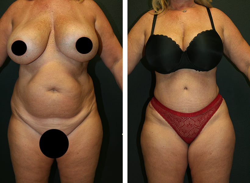 Before after tummy tuck 02