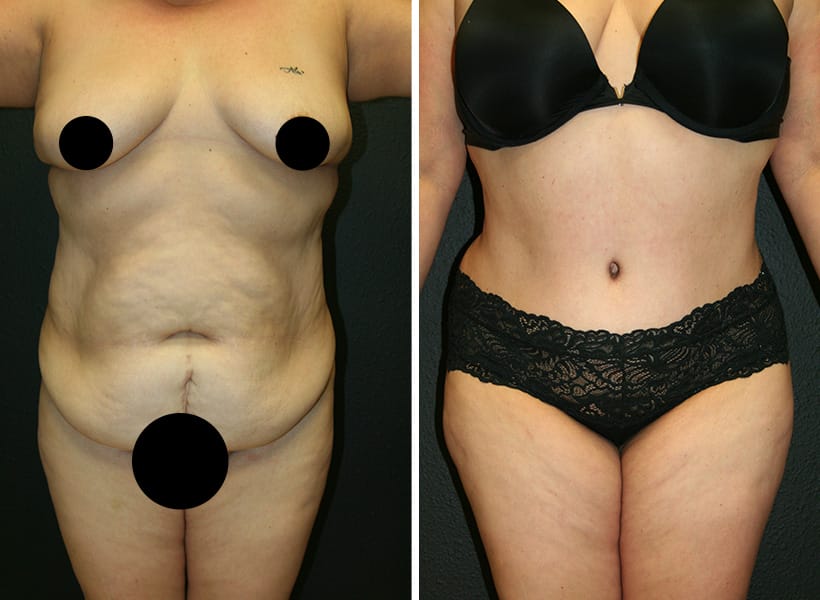 Before after tummy tuck 01