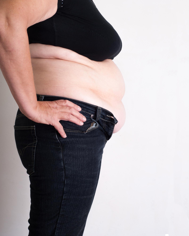 Modal showing Reverse Tummy Tuck
