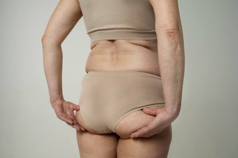 Liposuction surgery in Sarasota