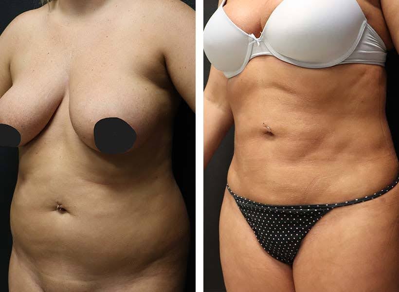 Liposuction before and after