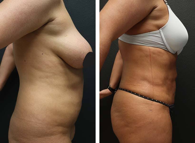 Liposuction before and after