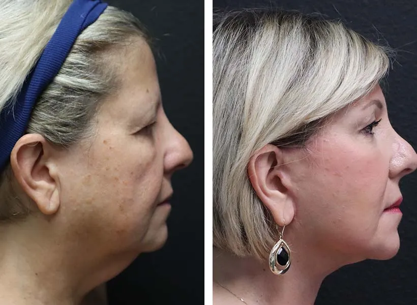 Before & after neck lift case 01