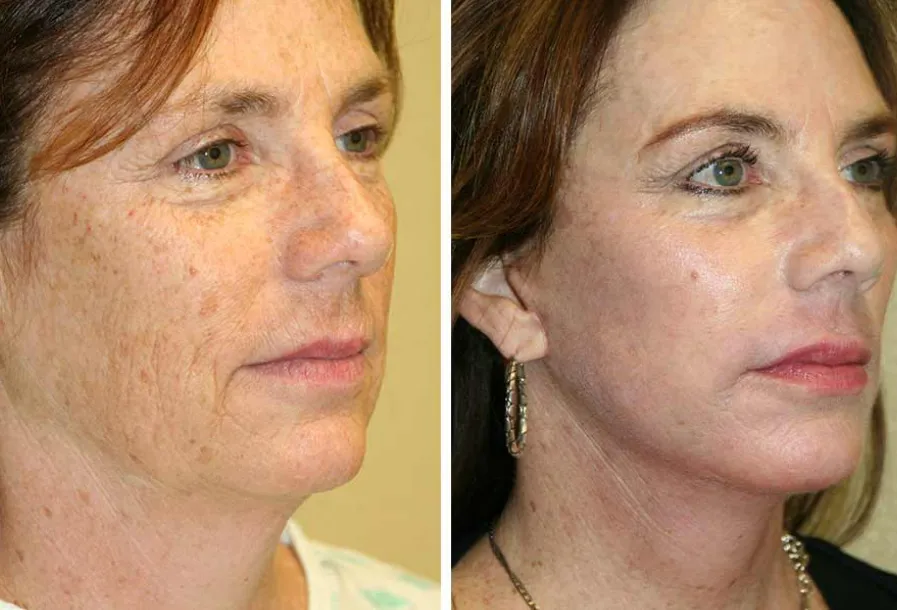 Before & after neck lift case 02