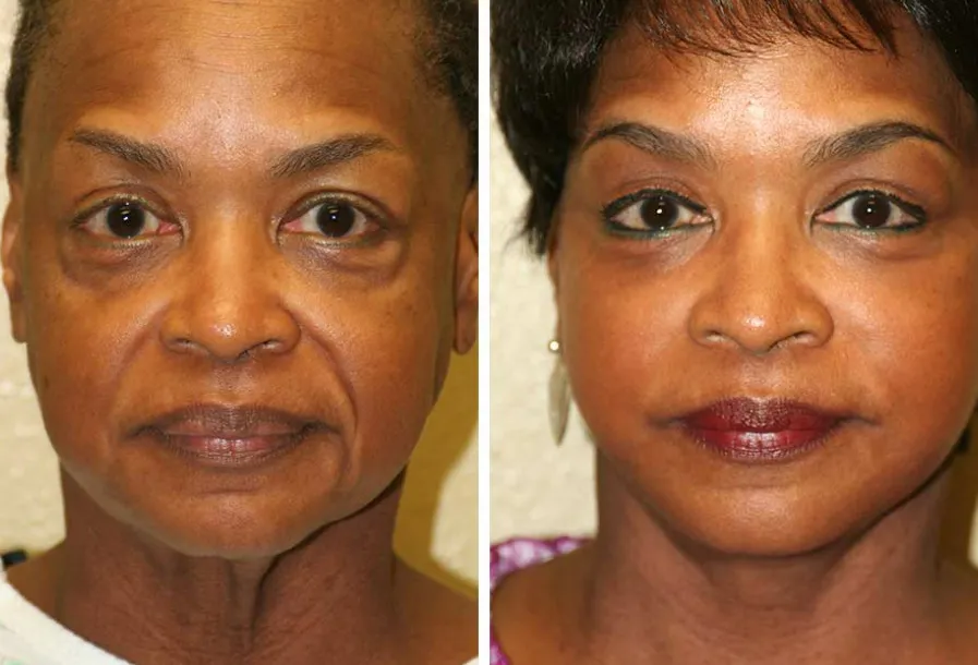 Before & after neck lift case 03