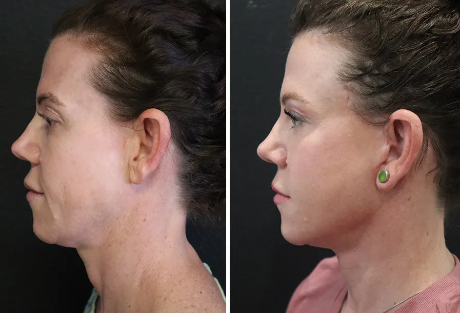 Before & after neck lift case 04