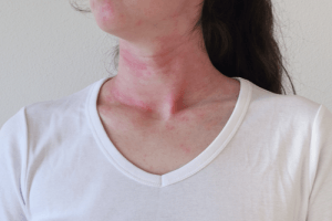 A Photo For A Blog Post About At What Age Should You Get A Neck Lift