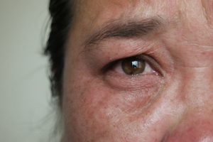 A Photo For Blog Post About How Many Years Does A Blepharoplasty Take Off