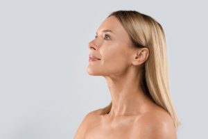 A model after radiesse procedure