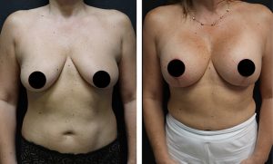 Breast Augmentation