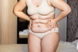 liposuction-belly-waist-fat