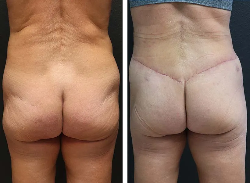Before & After Brazilian Butt Lift case 02