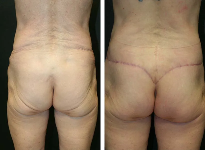 Before & After Brazilian Butt Lift case 01