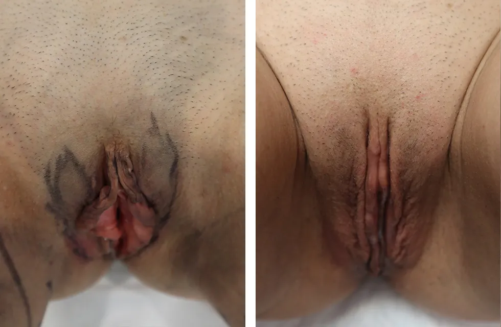 Before & After Labiaplasty case 01