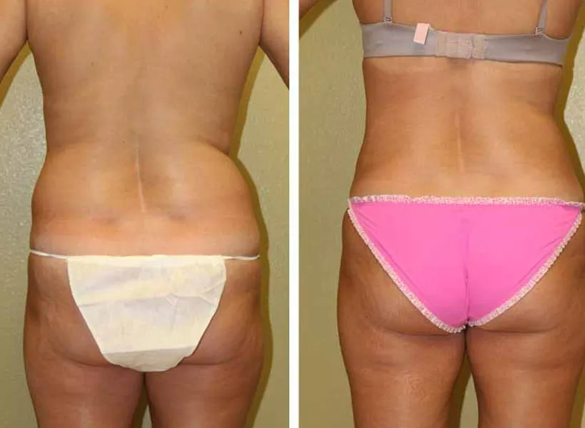 Before & after liposuction case 01