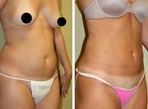 Before & after liposuction case 02