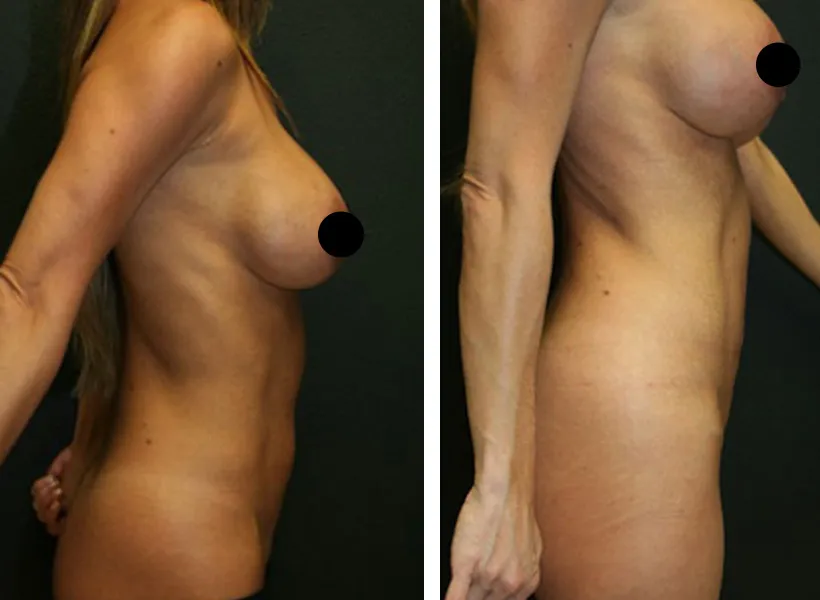 Before & after Mini Tummy Tuck case 01