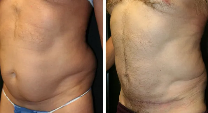 Before & after Mini Tummy Tuck case 02
