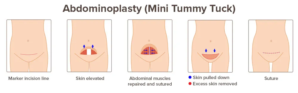 Images displaying typical results of mini tummy tuck surgery in Sarasota