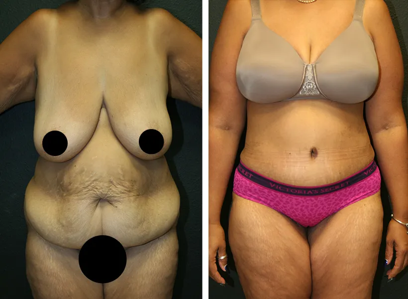 Before & after tummy tuck case 01