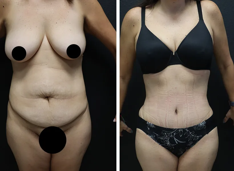 Before & after tummy tuck case 02