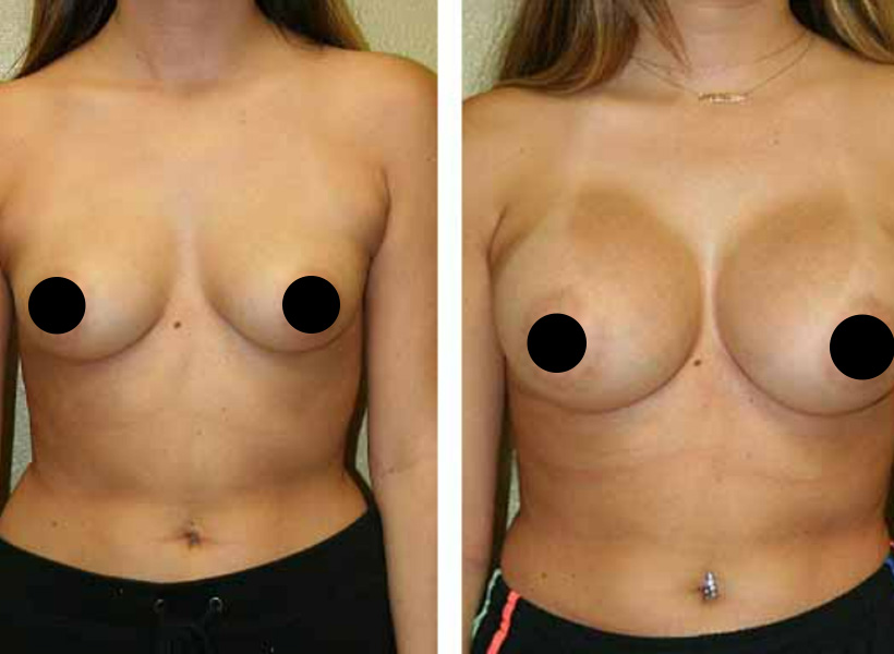 Before & After Breast Augmentation Results
