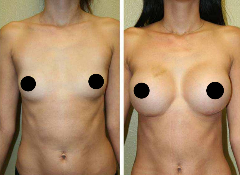 Before & After Breast Implants Result
