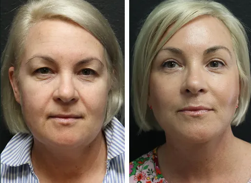 Buccal Fat Removal 01