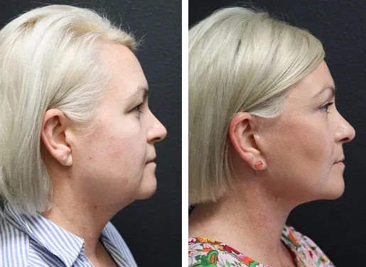 Buccal Fat Removal 02