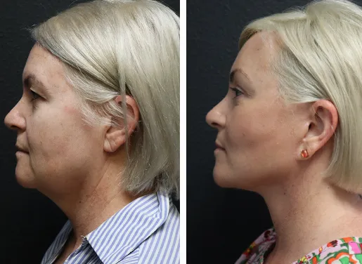 Buccal Fat Removal 03
