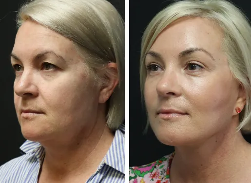 Buccal Fat Removal 04