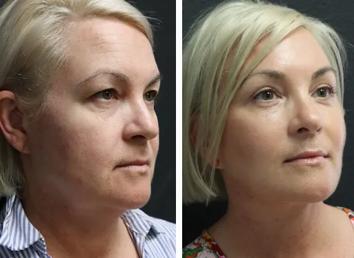 Buccal Fat Removal 05