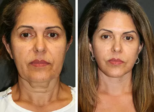 Facelift With Neck Lift 01