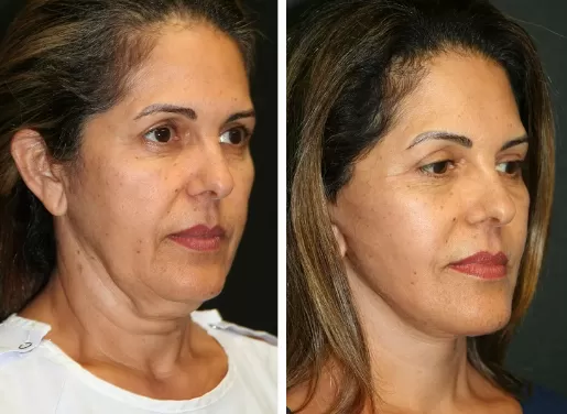 Facelift With Neck Lift 02